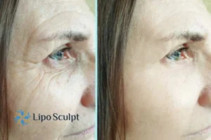 How to Fight Aging Symptoms 2 Do you want to Fight Aging Symptoms Castle Donington? Contact Lipo Sculpt today!