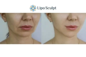 Explaining Total Skin Tightening Treatment And What It Can Do For You 2 Do you want to boost your self confidence? Give Morpheus8 Castle Donington a try today!