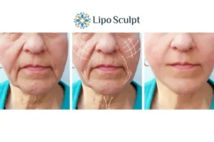 Explaining Total Skin Tightening Treatment And What It Can Do For You 3 Boost your confidence with Morpheus8 Castle Donington call our team today!