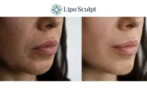 Explaining Total Skin Tightening Treatment And What It Can Do For You 4 Morpheus8 Castle Donington the best results - call our team today!