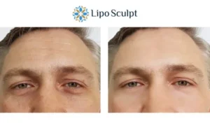 Explaining Total Skin Tightening Treatment And What It Can Do For You 6 Morpheus8 Castle Donington book in today to find out more!