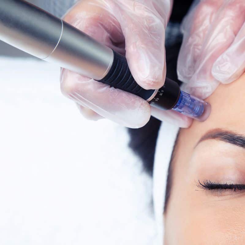 Morpheus8 treatment Castle Donington from Lipo Sculpt - Book in today!