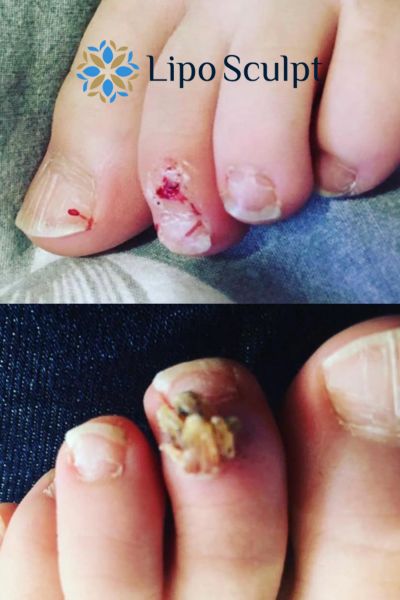 Wart removal customer results from Lipo Sculpt Castle Donington